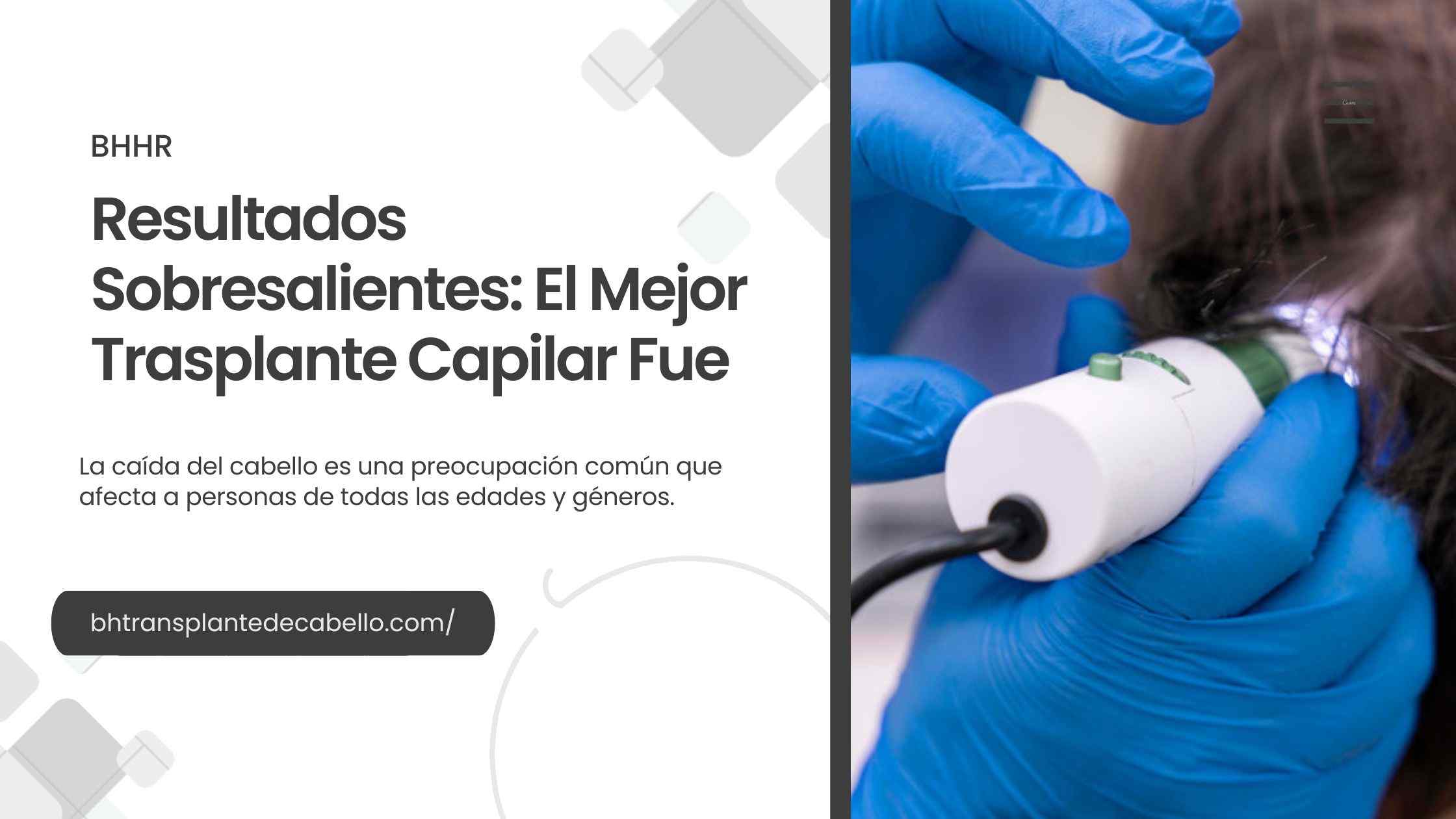 Resultados Sobresalientes: El Mejor Trasplante Capilar Fue